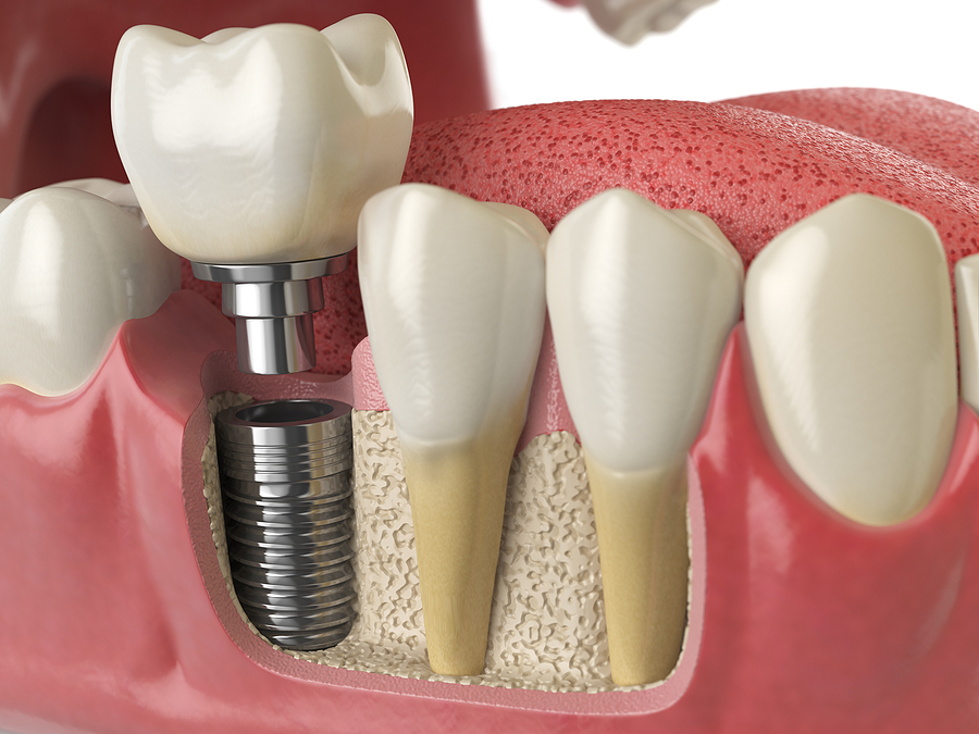 Restore Your Smile with Dental Implants in Stratford, CT