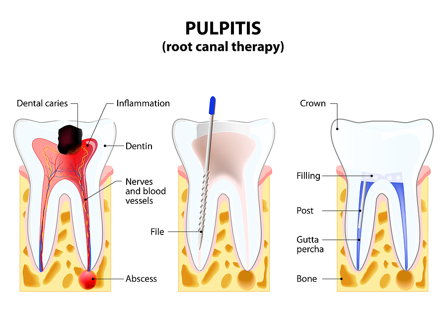 The Importance of Root Canals in Maintaining Your Oral Health