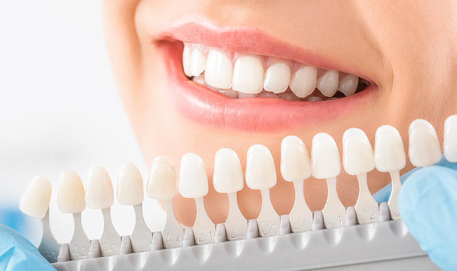 Brighten Your Smile: A Comprehensive Guide to Teeth Whitening