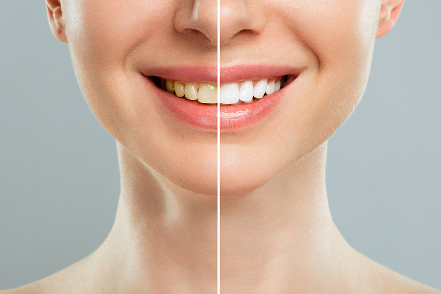 Brighten Your Smile with Professional Teeth Whitening in Stratford, CT